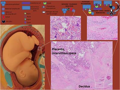 Human Leukocyte Antigens in Pregnancy and Preeclampsia